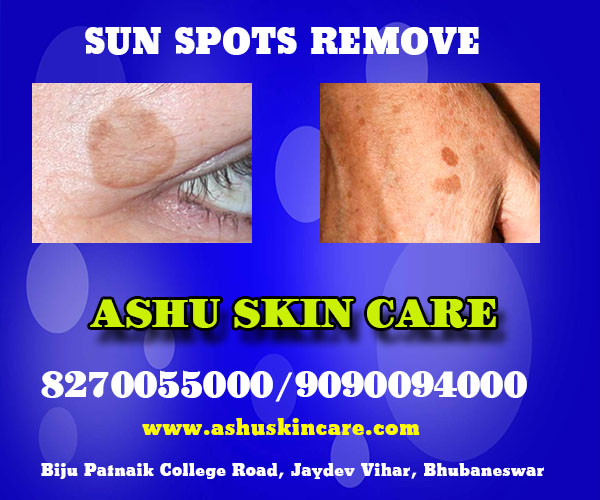 best sun spots removal clinic in bhubaneswar near me
